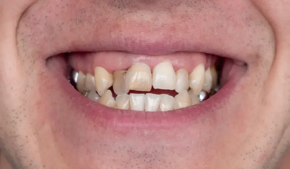 Close-up of a smile with crowded, misaligned teeth