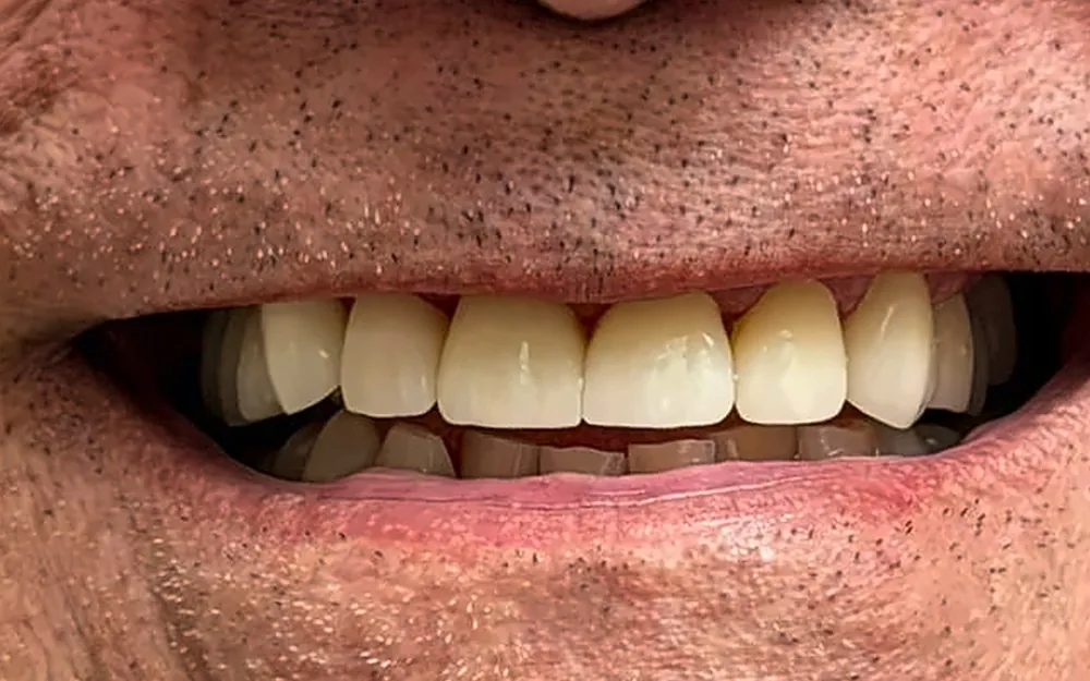 The same patient’s smile after treatment