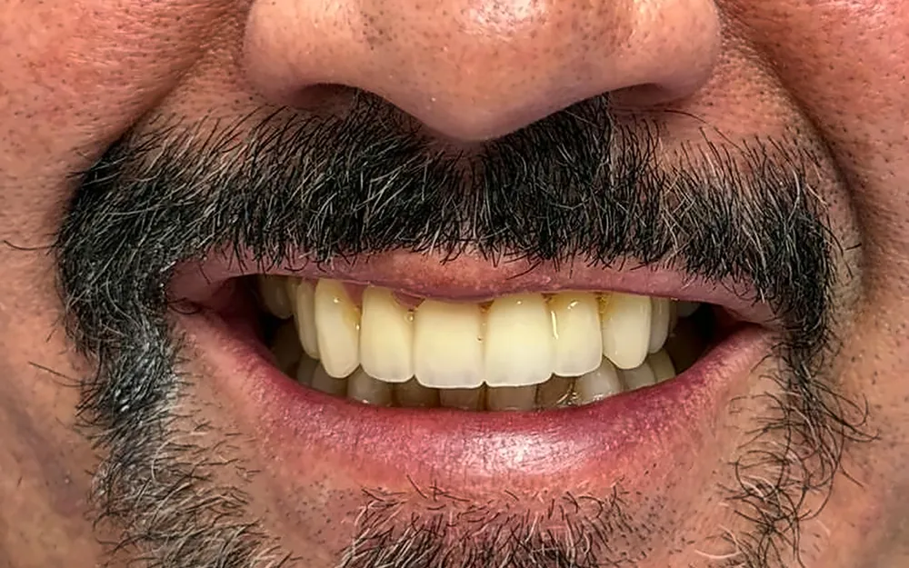 The same patient’s smile after treatment