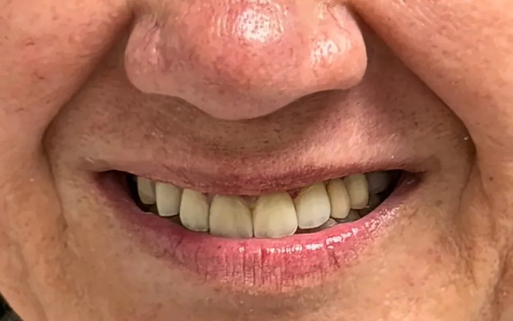 The same patient’s smile after treatment