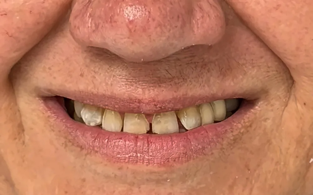 Patient’s smile before treatment