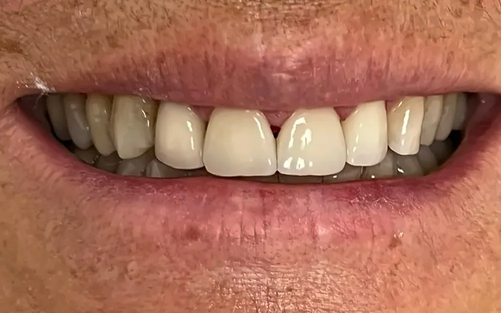 The same patient’s smile after treatment