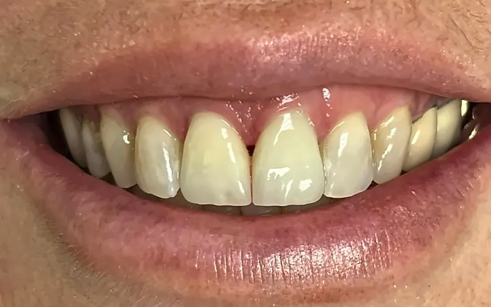The same patient’s smile after treatment
