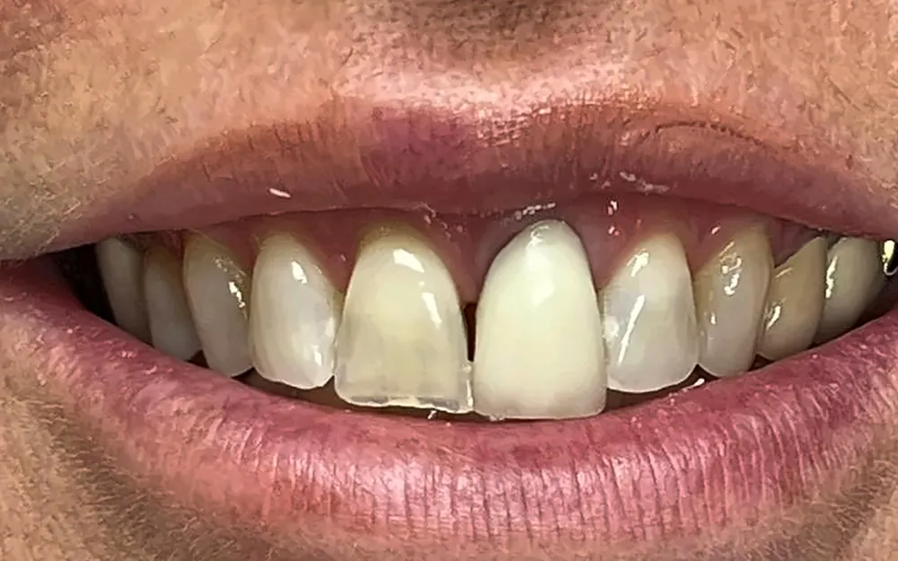 Patient’s smile before treatment