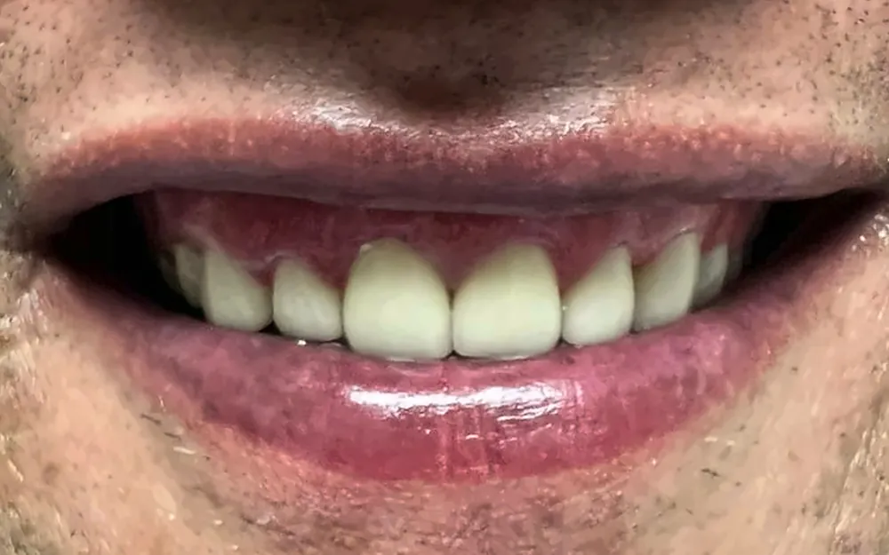The same patient’s smile after treatment