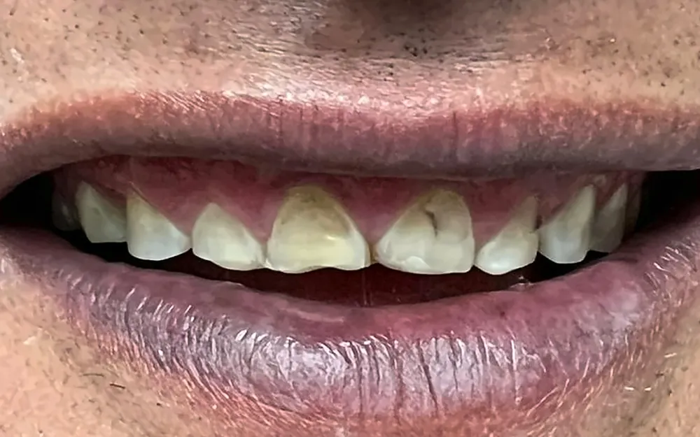 Patient’s smile before treatment