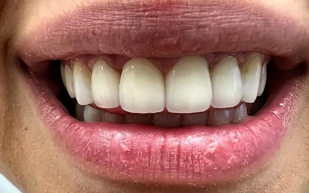 The same patient’s smile after treatment