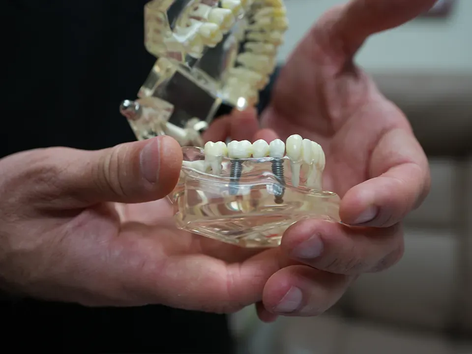 Dental implant model