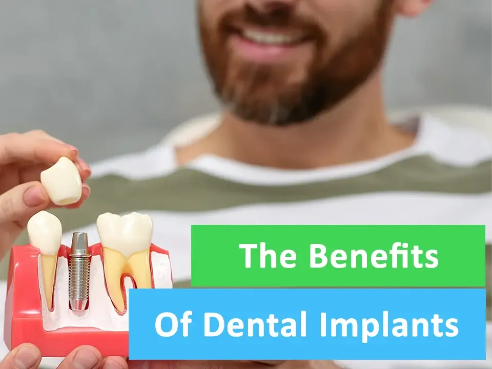 The Benefits of Dental Implants
