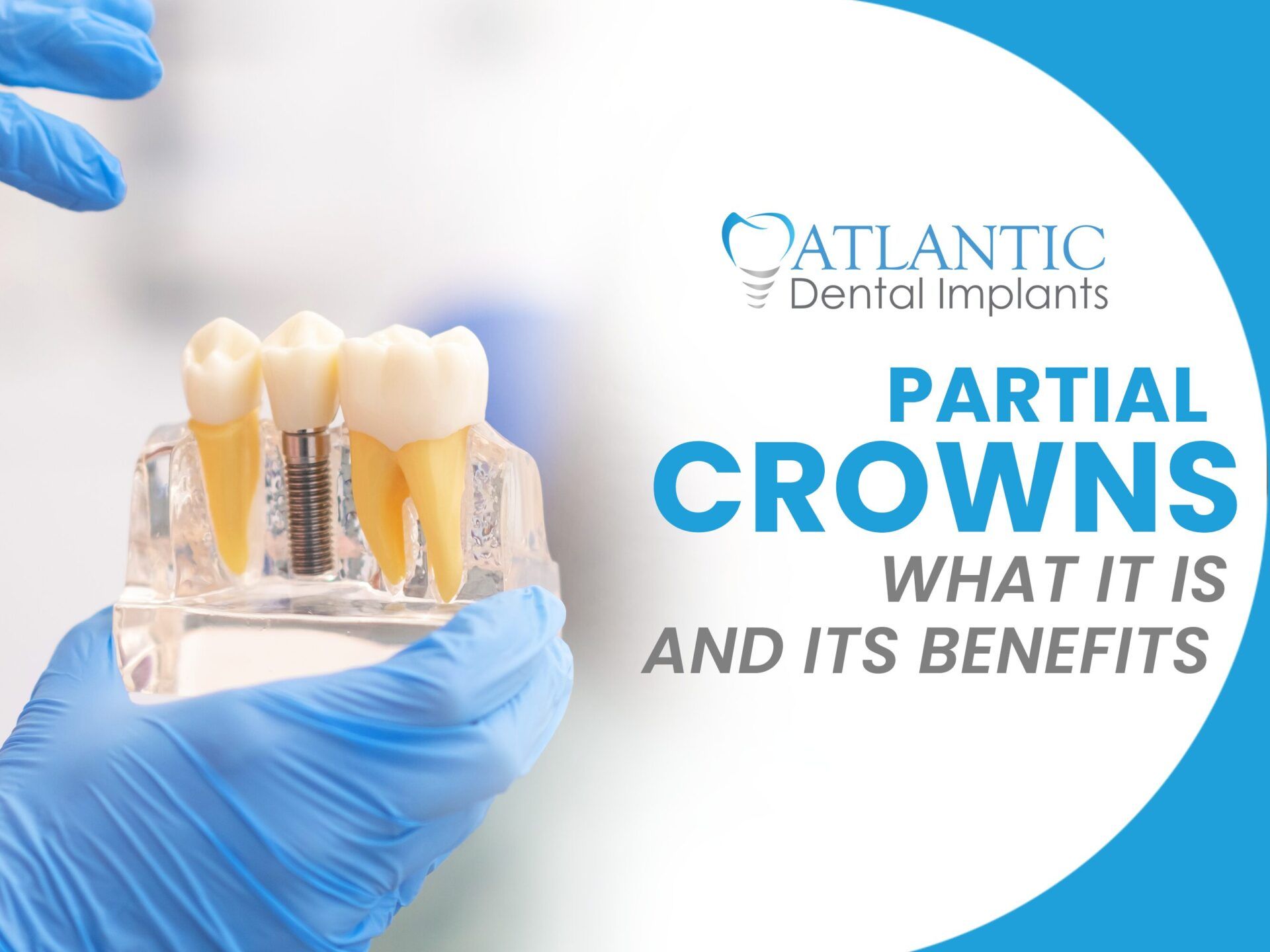Partial Crown – What It Is and Its Benefits