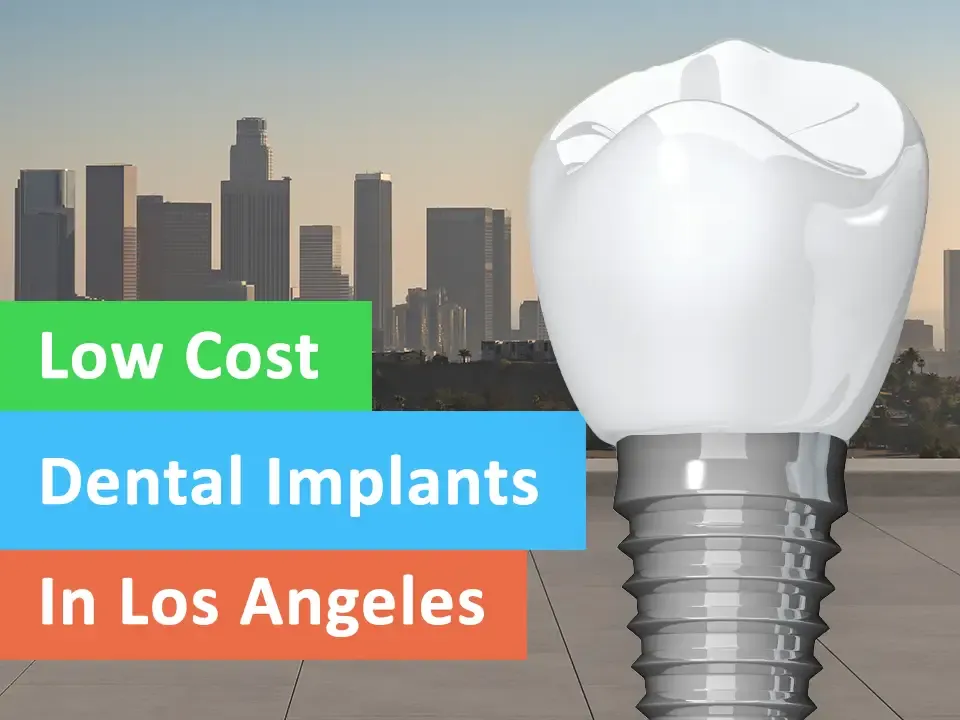 Low Cost Dental Implants in Los Angeles