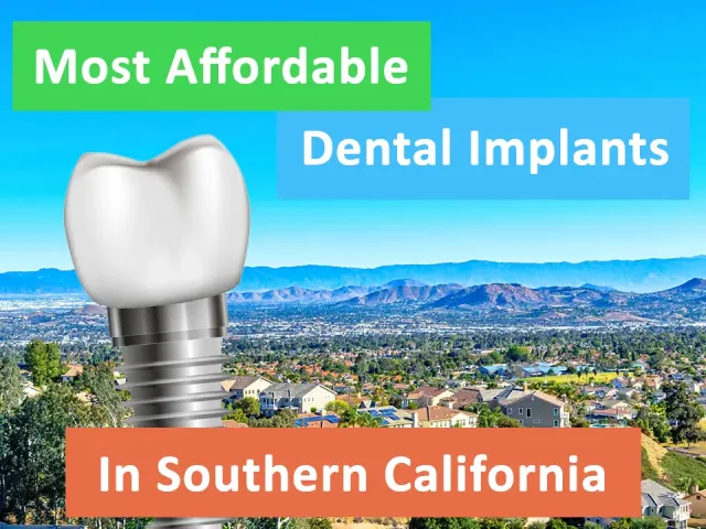 The Most Affordable Dental Implants in Southern California