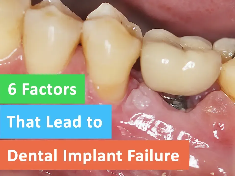 6 Factors that Lead to Dental Implant Failure