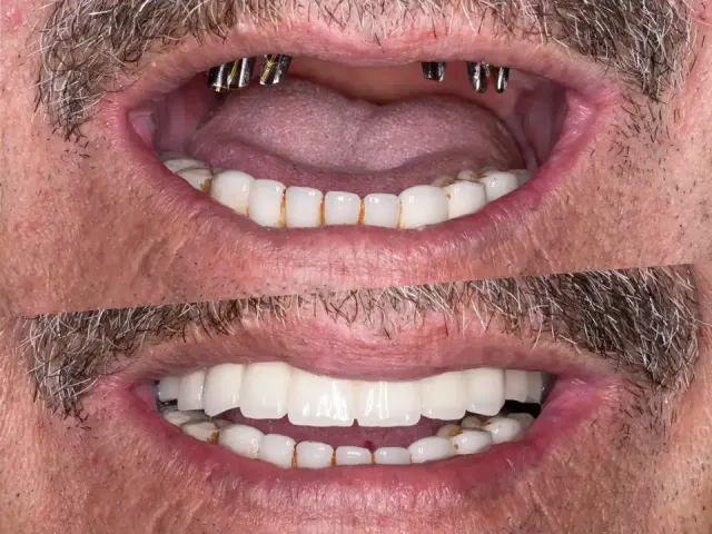Permanent Replacement Teeth Benefits