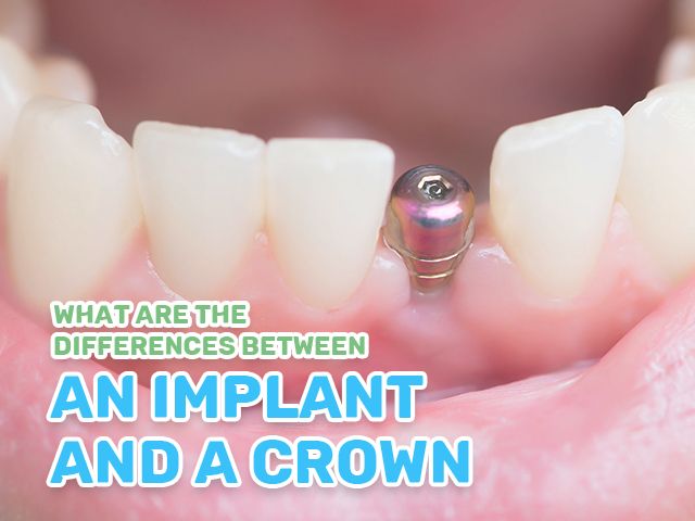 Dental Implants Vs. Crowns – What’s the Difference?
