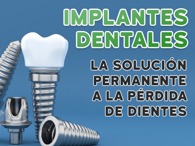 Implantes Dentales: La Solución Permanente a la Pérdida de Dientes