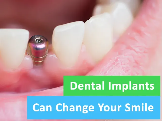 Dental Implants Can Change Your Smile for the Best