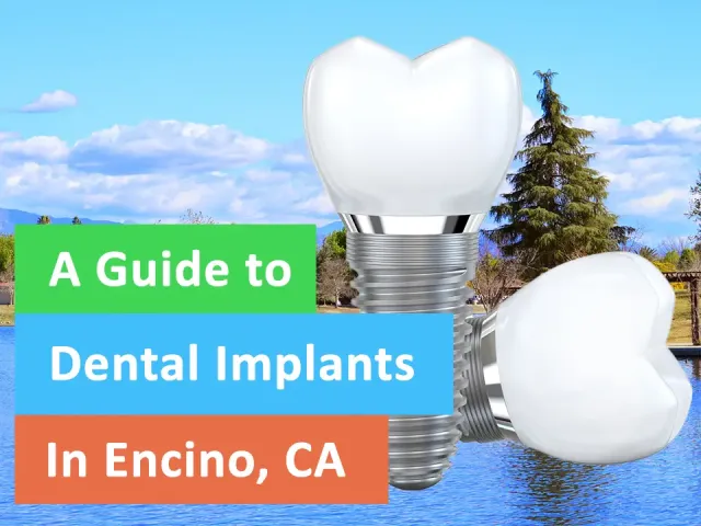 A Guide to the Cost of Dental Implants in Encino, CA