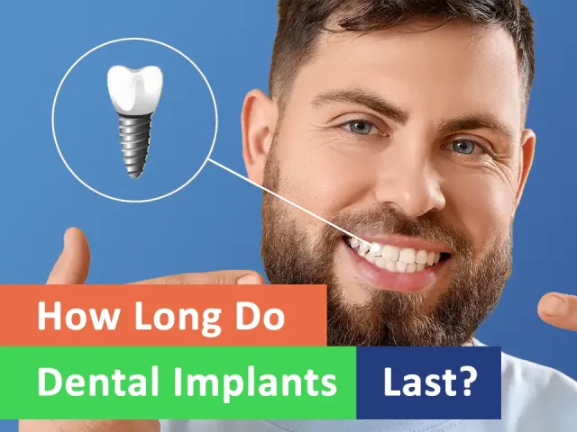 How Long Do Dental Implants Last?