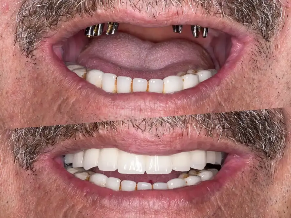 Permanent Replacement Teeth Benefits