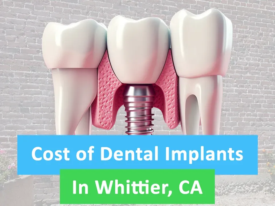 The Cost of Dental Implants in Whittier, CA