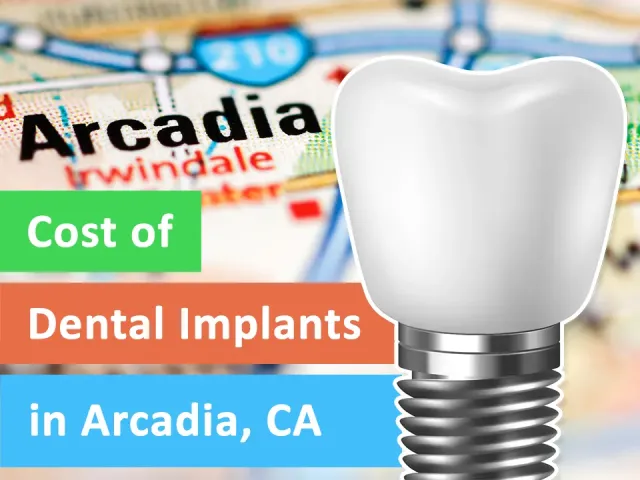 The Cost of Dental Implants in Arcadia, California