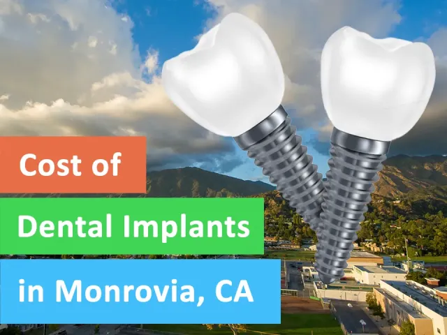 Cost of Dental Implants in Monrovia, CA