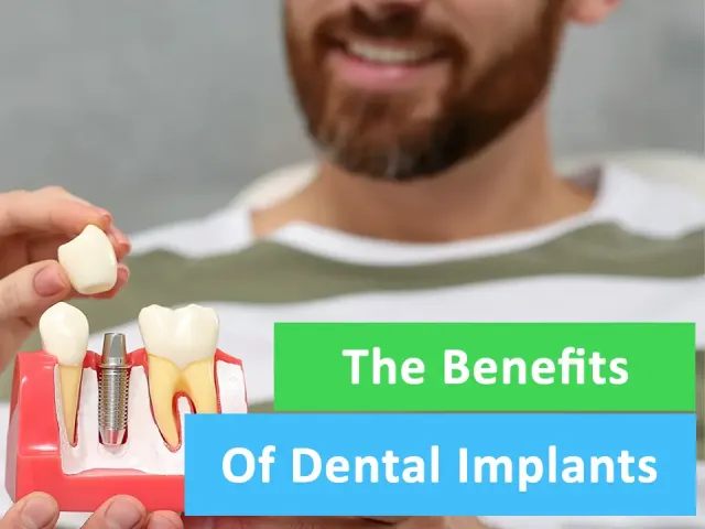 The Benefits of Dental Implants