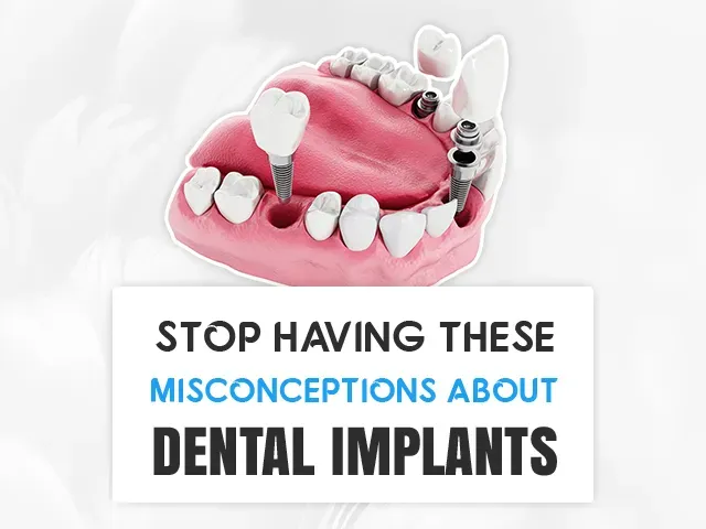 Stop With these Misconceptions About Dental Implants