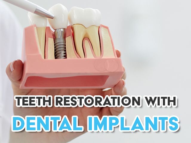 Teeth Restoration with Dental Implants