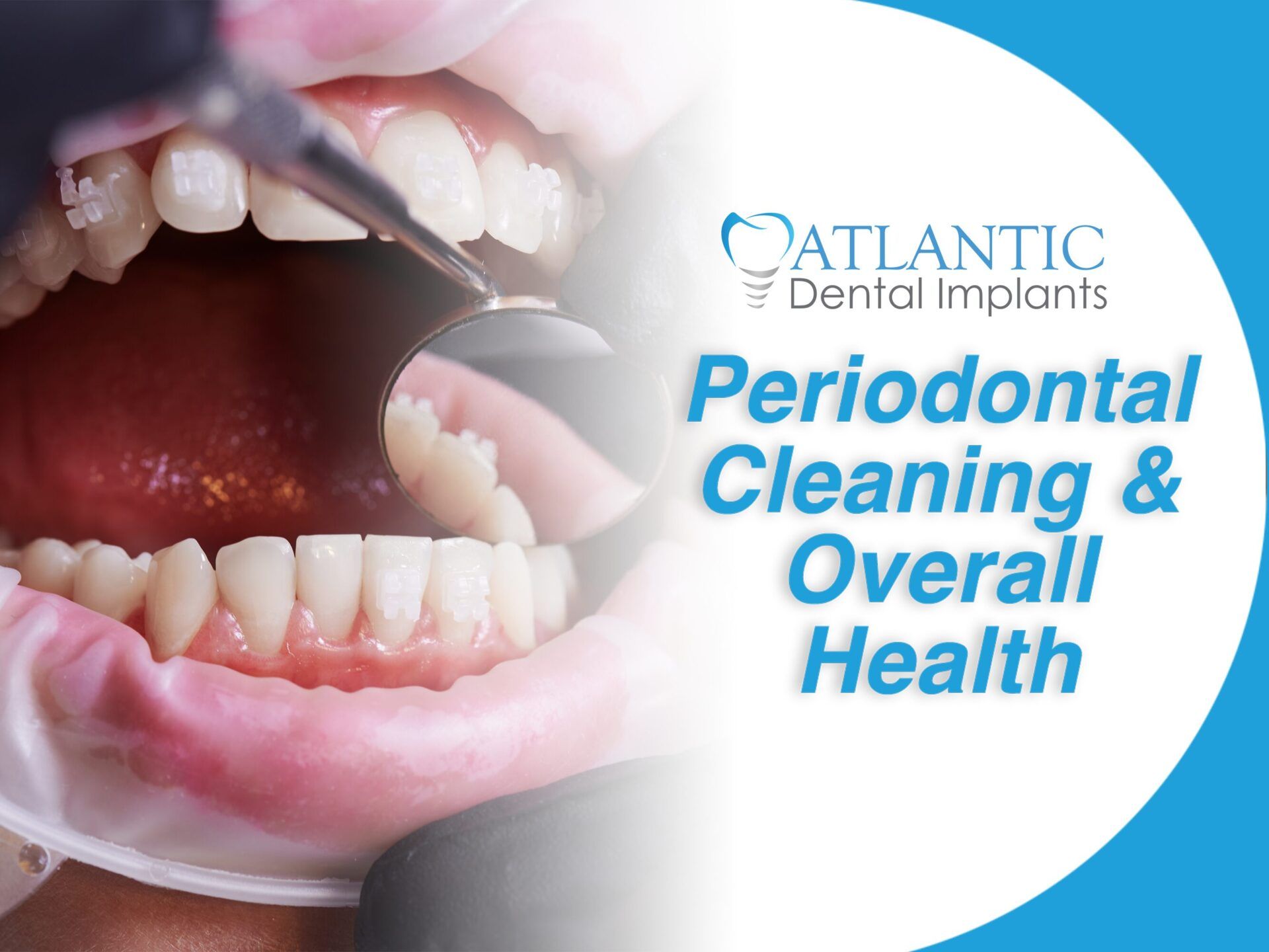 periodontal cleaning atlantic dental group whittier ca