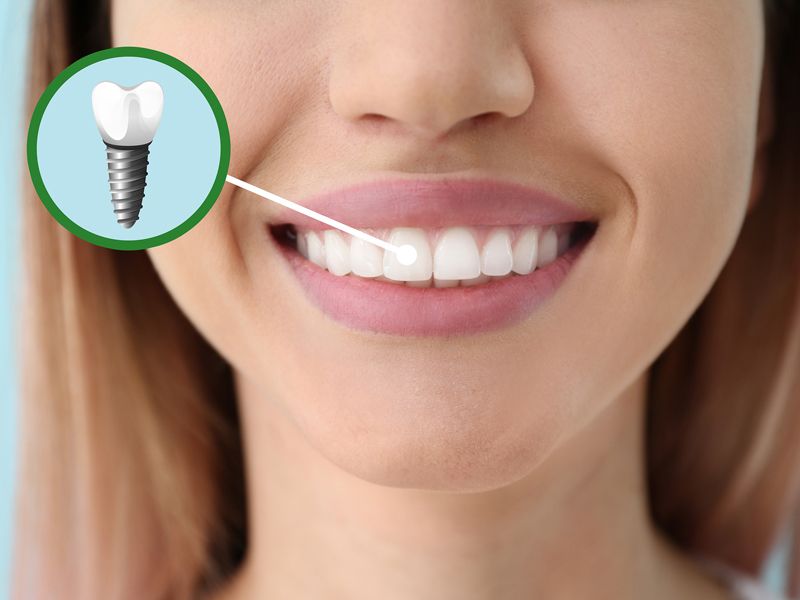 Dental Implants