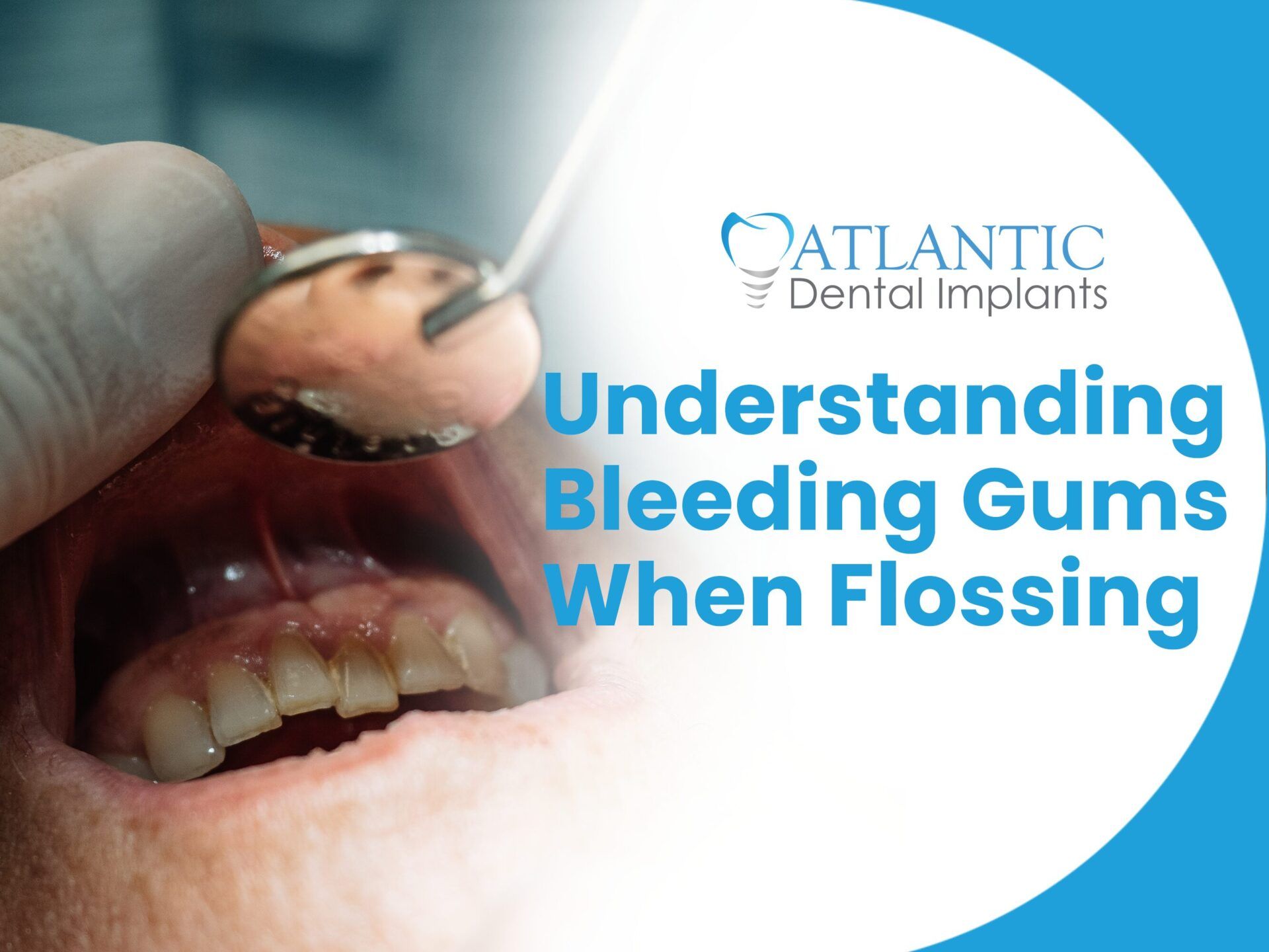 Why Do You Have Bleeding Gums When Flossing? Causes, Solutions, and Prevention