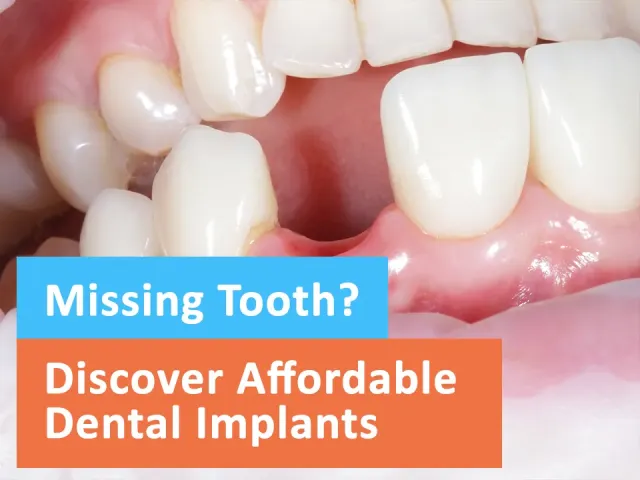 Missing Tooth? Discover Affordable Dental Implants