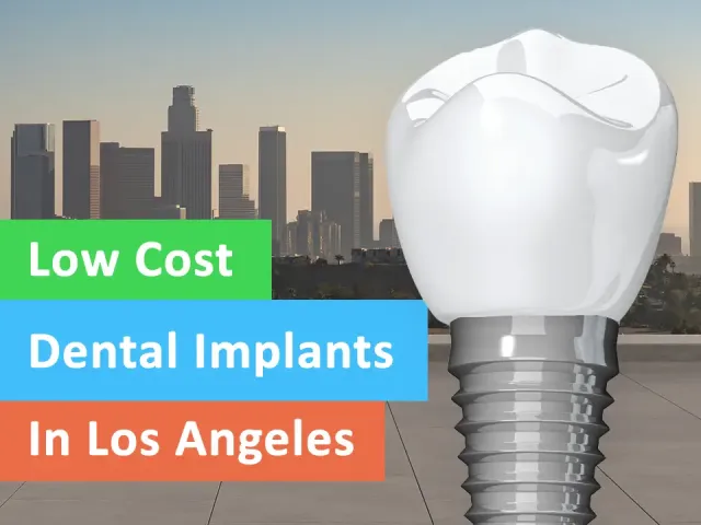 Low Cost Dental Implants in Los Angeles