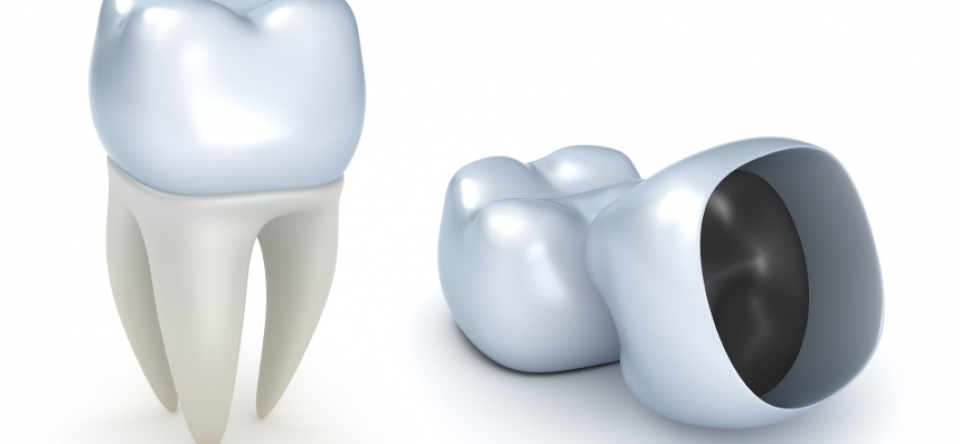 Dental Crowns