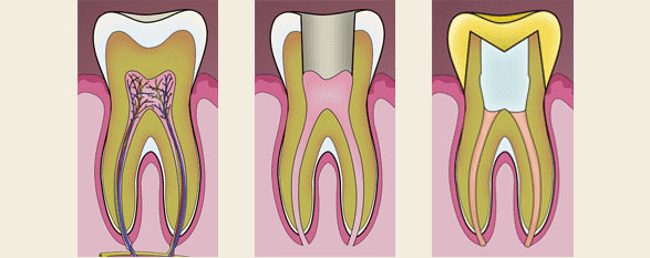 Root Canal Treatment at Atlantic Dental Group