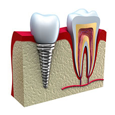 Dental Implant Diagram Compared to a Natural Live Tooth