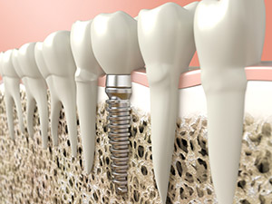 Image of a Strong Jawbone Supported by a Dental Implant, Thanks to Bone Grafting
