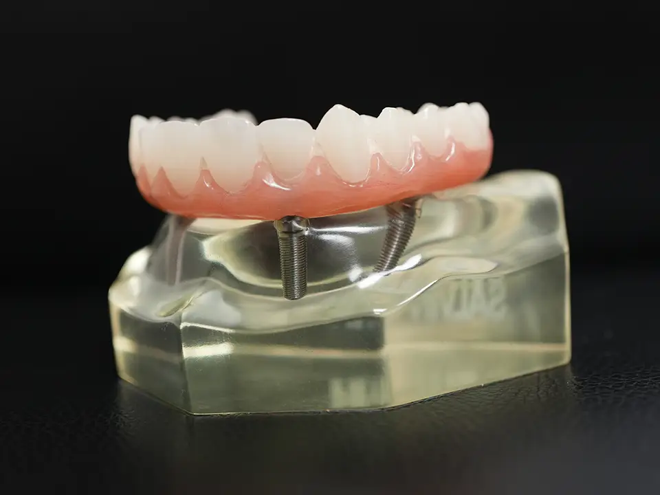 All on X dental implants concept at Atlantic Dental Group