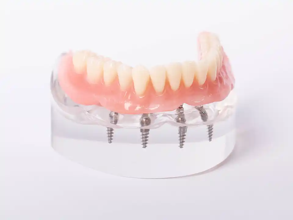 All on X Dental Implants