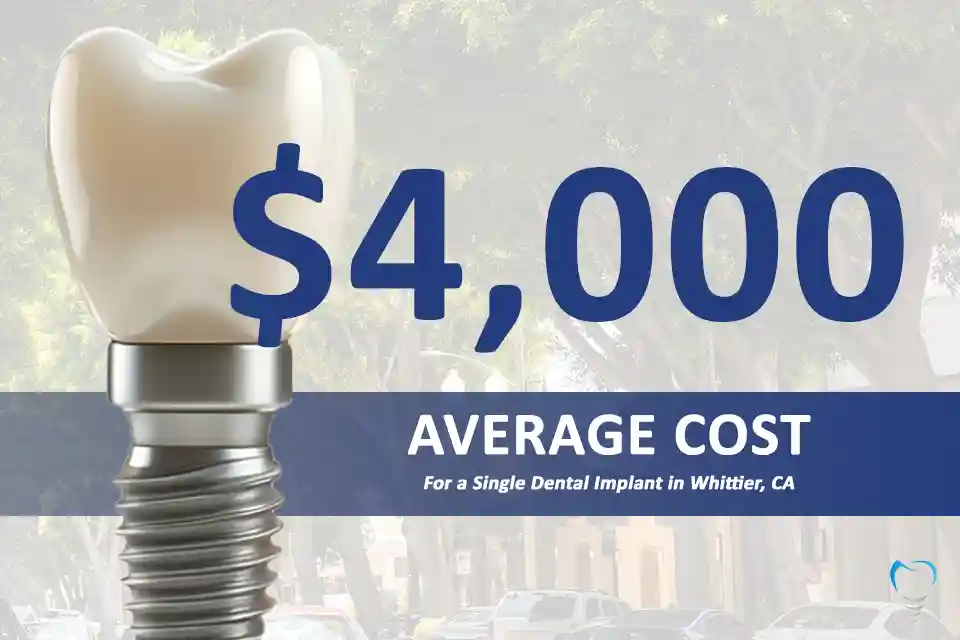 Average Cost of Dental Implants in Whittier