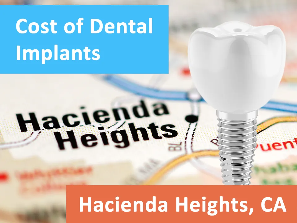 The Ultimate Guide to Dental Implants - Hacienda Heights, CA