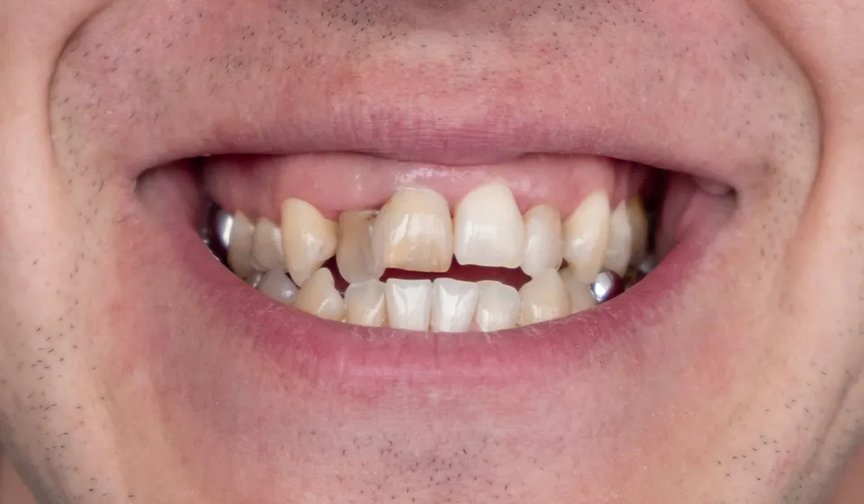Misaligned teeth