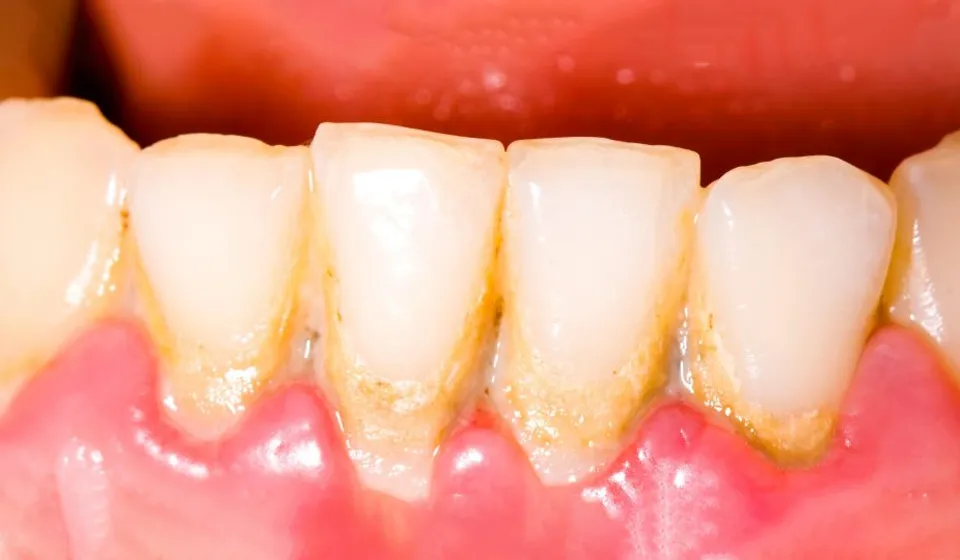 Plaque on teeth